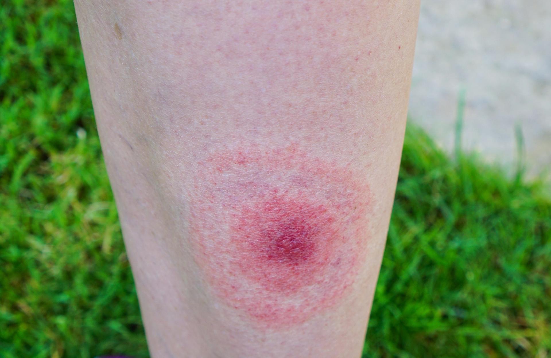 Lyme Disease Cases Up 168% in Michigan Since 2020