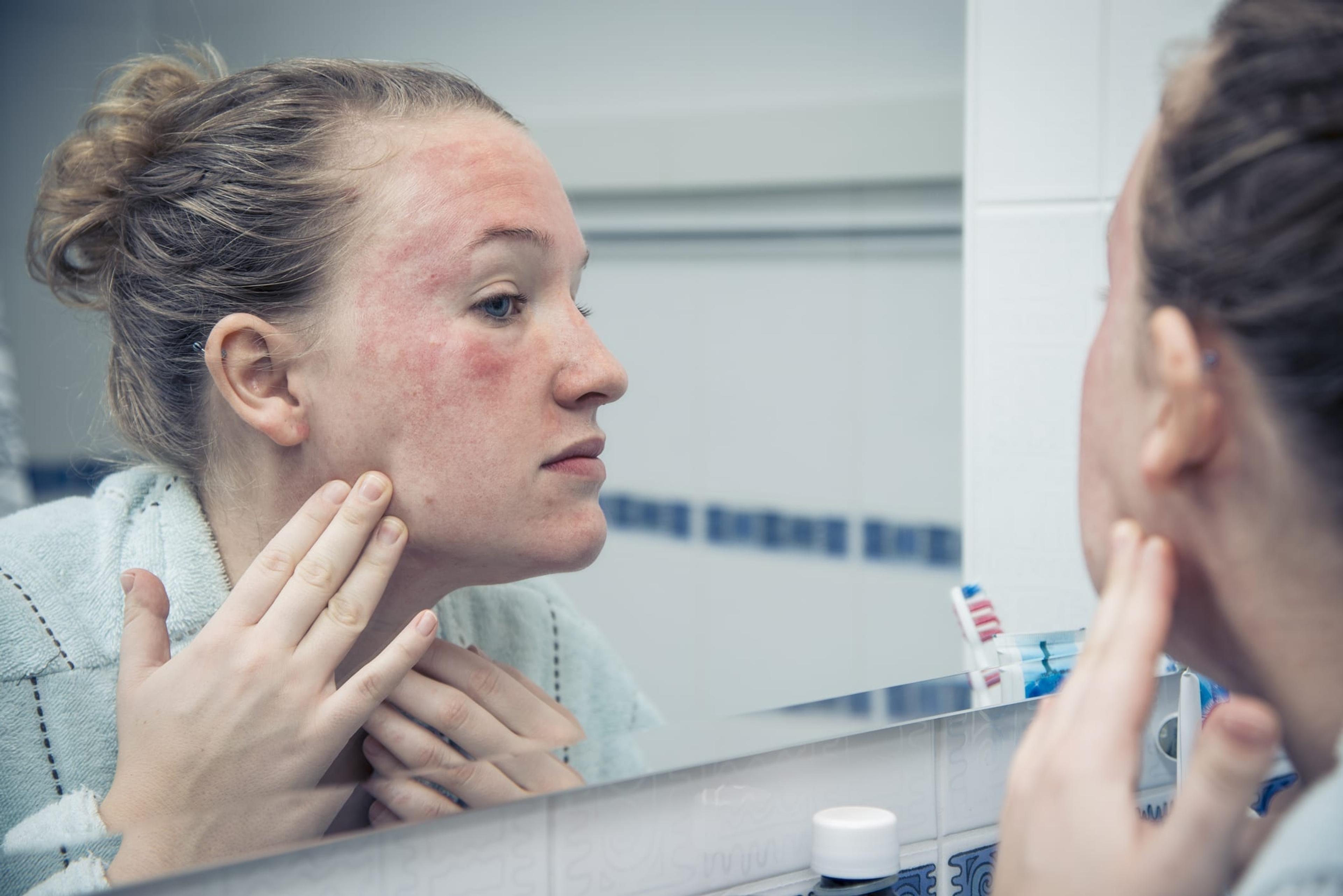 Woman with allergic reaction looking herself in the mirror.