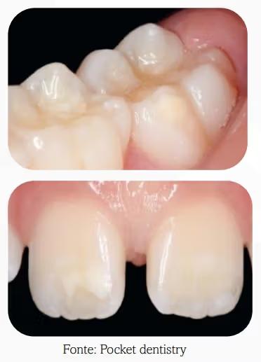 Manchas brancas amareladas e dentes sensíveis nas crianças? Pode ser HMI!