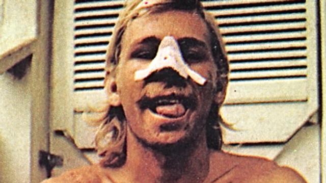 Jeff Crawford, North Shore injuries, 1974. Photo: Jeff Divine