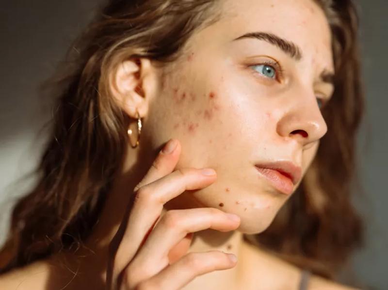 Acne: A personal Journey 