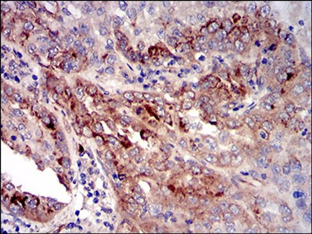 Immunohistochemistry: IGFBP-rp1/IGFBP-7 Antibody (1D9E7) [NBP2-37313] - Immunohistochemical analysis of paraffin-embedded cervical cancer tissues using CK5 mouse mAb with DAB staining.