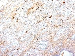 Formalin-fixed, paraffin-embedded human pancreatic adenocarcinoma stained with Fibronectin antibody (SPM246).