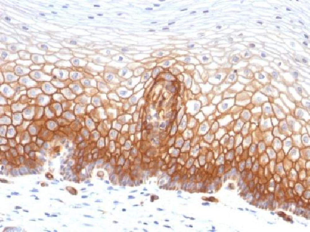 Immunohistochemical staining of human Cervical Carcinoma tissue using THBD antibody