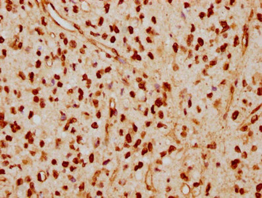 IHC image of CSB-RA013003A0HU diluted at 1:115 and staining in paraffin-embedded human glioma cancer performed on a Leica BondTM system. After dewaxing and hydration, antigen retrieval was mediated by high pressure in a citrate buffer (pH 6.0). Section was blocked with 10% normal goat serum 30min at RT. Then primary antibody (1% BSA) was incubated at 4℃ overnight. The primary is detected by a biotinylated secondary antibody and visualized using an HRP conjugated SP system.