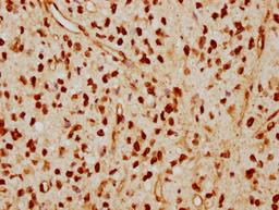 IHC image of CSB-RA013003A0HU diluted at 1:115 and staining in paraffin-embedded human glioma cancer performed on a Leica BondTM system. After dewaxing and hydration, antigen retrieval was mediated by high pressure in a citrate buffer (pH 6.0). Section was blocked with 10% normal goat serum 30min at RT. Then primary antibody (1% BSA) was incubated at 4℃ overnight. The primary is detected by a biotinylated secondary antibody and visualized using an HRP conjugated SP system.