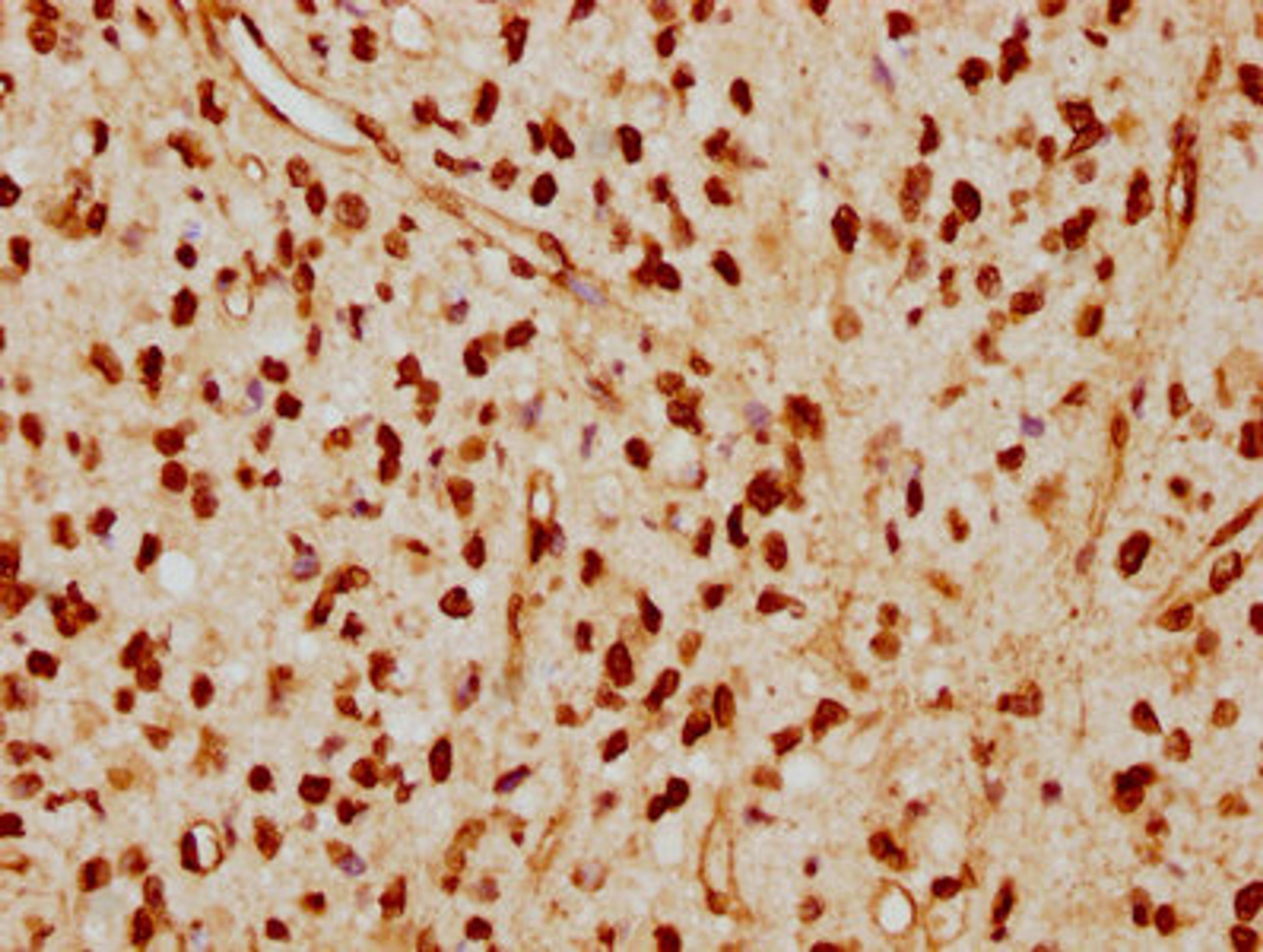 IHC image of CSB-RA013003A0HU diluted at 1:115 and staining in paraffin-embedded human glioma cancer performed on a Leica BondTM system. After dewaxing and hydration, antigen retrieval was mediated by high pressure in a citrate buffer (pH 6.0). Section was blocked with 10% normal goat serum 30min at RT. Then primary antibody (1% BSA) was incubated at 4℃ overnight. The primary is detected by a biotinylated secondary antibody and visualized using an HRP conjugated SP system.