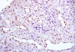 Immunohistochemical analysis of formalin-fixed paraffin embedded Human gastric cancer tissue using HPV18 E6 antibody (dilution at 1:200)