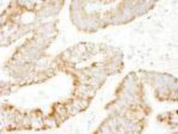 Immunohistochemistry-Paraffin: RAPGEF2 Antibody [NBP1-06549] - FFPE section of human lung adenocarcinoma. Affinity purified rabbit anti-PDZ-GEF1 used at a dilution of 1:250. Detection: DAB staining using Immunohistochemistry Accessory Kit. Epitope Retrieval Buffer-High pH was substituted for Epitope Retrieval Buffer-Reduced pH.