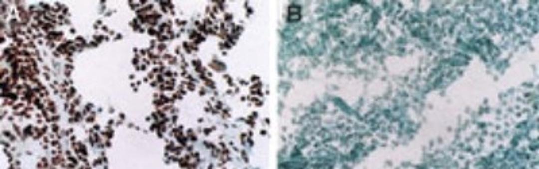 Immunohistochemistry: MyoD1 Antibody (5.8A) [NB100-56511] - IHC (F) using the MyoD1, Clone 5.8A antibody in human tissues. A. Rhabdomyosaroma (nuclei are stained), B. Lymphoma (staining is absent)