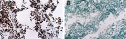 Immunohistochemistry: MyoD1 Antibody (5.8A) [NB100-56511] - IHC (F) using the MyoD1, Clone 5.8A antibody in human tissues. A. Rhabdomyosaroma (nuclei are stained), B. Lymphoma (staining is absent)