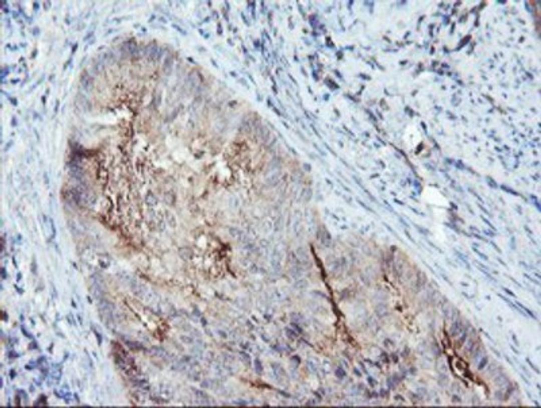 Immunohistochemistry-Paraffin: Syntenin 1 Antibody (2H6) [NBP2-02072] - Staining of paraffin-embedded Adenocarcinoma of Human endometrium tissue using anti-Syntenin 1 mouse monoclonal antibody.