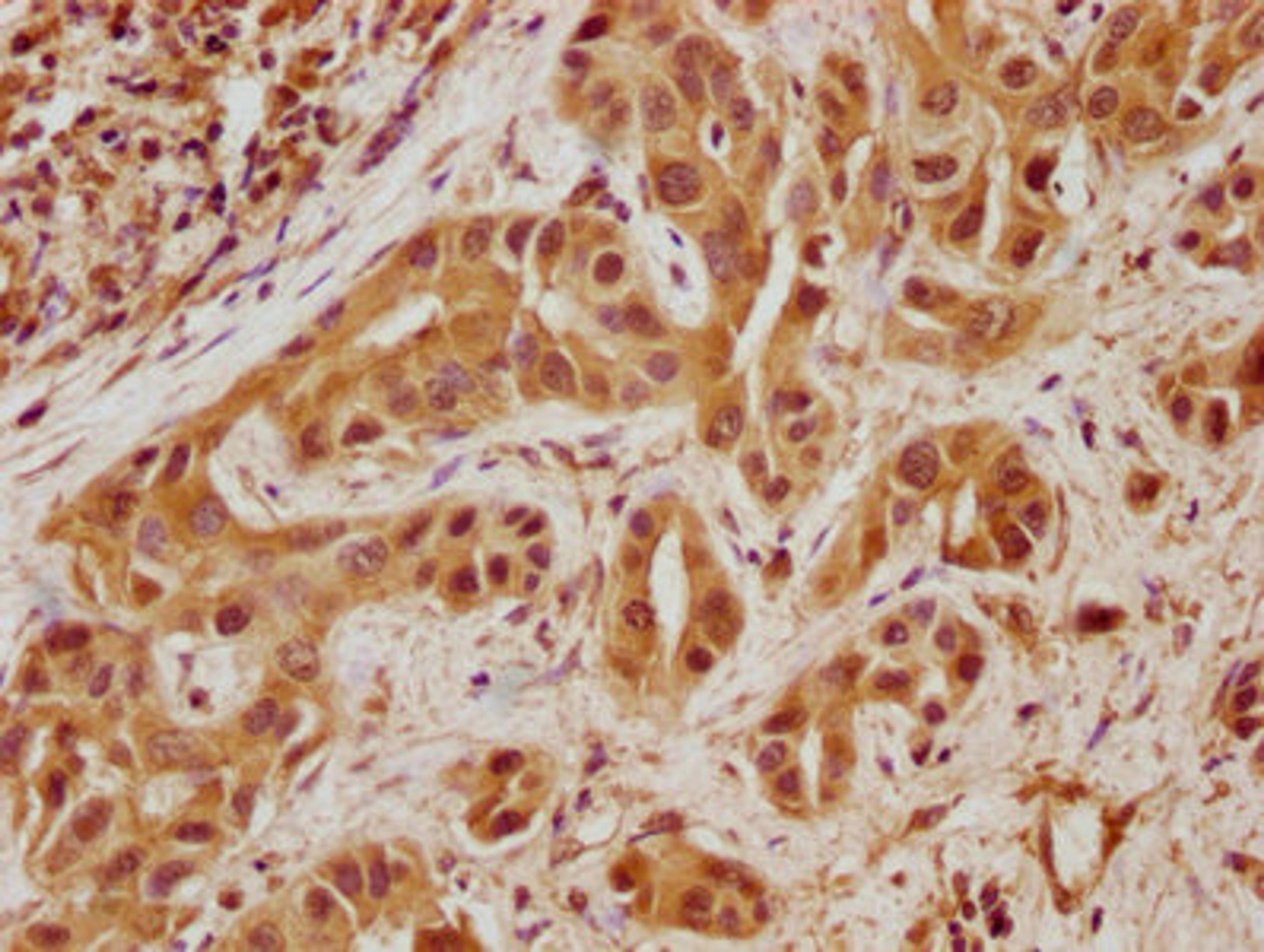 IHC image of CSB-PA810319LA01HU diluted at 1:100 and staining in paraffin-embedded human liver cancer performed on a Leica BondTM system. After dewaxing and hydration, antigen retrieval was mediated by high pressure in a citrate buffer (pH 6.0). Section was blocked with 10% normal goat serum 30min at RT. Then primary antibody (1% BSA) was incubated at 4°C overnight. The primary is detected by a biotinylated secondary antibody and visualized using an HRP conjugated SP system.