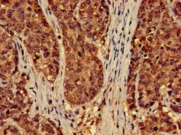 Immunohistochemistry of paraffin-embedded human ovarian cancer using CSB-PA856907LA01HU at dilution of 1:100