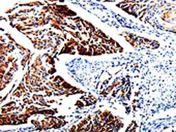 The image is immunohistochemistry of paraffin-embedded Human cervical cancer tissue using CSB-PA917452(TUBB3 Antibody) at dilution 1/25. (Original magnification: ×200)