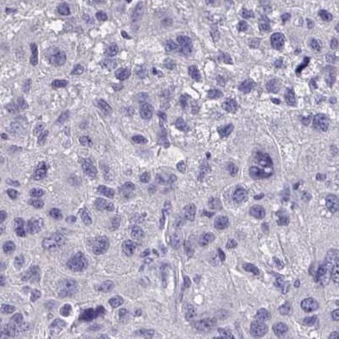 Immunohistochemistry: FAM9C Antibody [NBP2-31834] - liver cancer