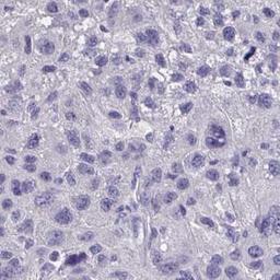 Immunohistochemistry: FAM9C Antibody [NBP2-31834] - liver cancer