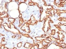 IHC staining of FFPE human angiocarcinoma with recombinant CD31 antibody (clone C31/1395R). Required HIER: steam sections in pH7.5-8.5, 1mM EDTA for 10-20 min.