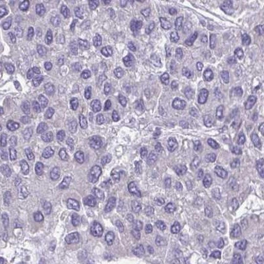 Immunohistochemistry: C4orf33 Antibody [NBP2-32585] - liver cancer