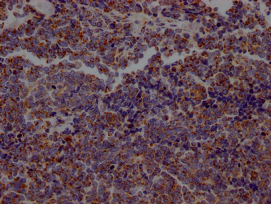 IHC image of CSB-RA218127A0HU diluted at 1:100 and staining in paraffin-embedded human lung cancer performed on a Leica BondTM system. After dewaxing and hydration, antigen retrieval was mediated by high pressure in a citrate buffer (pH 6.0). Section was blocked with 10% normal goat serum 30min at RT. Then primary antibody (1% BSA) was incubated at 4℃ overnight. The primary is detected by a Goat anti-rabbit IgG polymer labeled by HRP and visualized using 0.05% DAB.