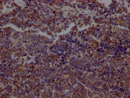 IHC image of CSB-RA218127A0HU diluted at 1:100 and staining in paraffin-embedded human lung cancer performed on a Leica BondTM system. After dewaxing and hydration, antigen retrieval was mediated by high pressure in a citrate buffer (pH 6.0). Section was blocked with 10% normal goat serum 30min at RT. Then primary antibody (1% BSA) was incubated at 4℃ overnight. The primary is detected by a Goat anti-rabbit IgG polymer labeled by HRP and visualized using 0.05% DAB.