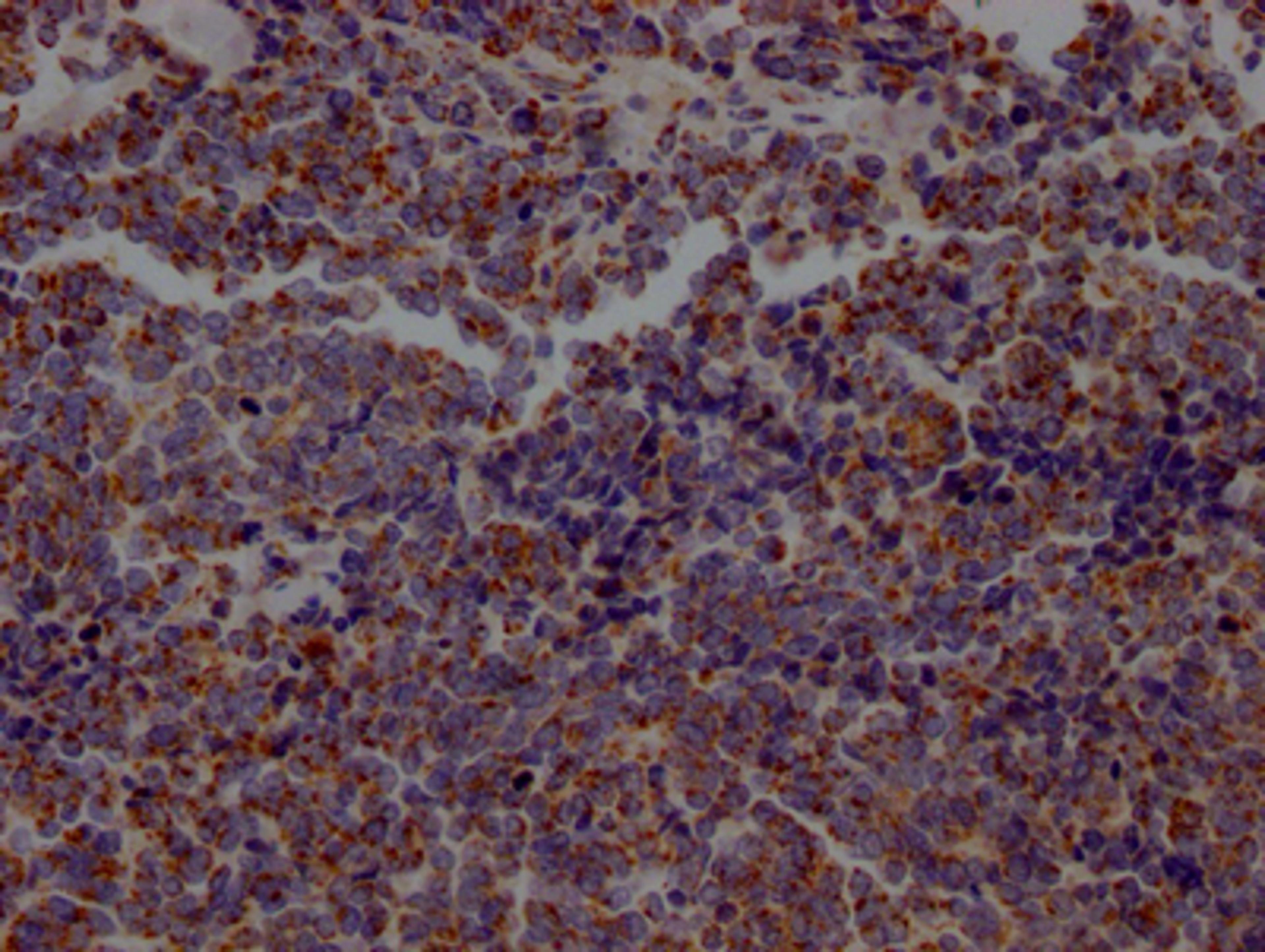 IHC image of CSB-RA218127A0HU diluted at 1:100 and staining in paraffin-embedded human lung cancer performed on a Leica BondTM system. After dewaxing and hydration, antigen retrieval was mediated by high pressure in a citrate buffer (pH 6.0). Section was blocked with 10% normal goat serum 30min at RT. Then primary antibody (1% BSA) was incubated at 4℃ overnight. The primary is detected by a Goat anti-rabbit IgG polymer labeled by HRP and visualized using 0.05% DAB.