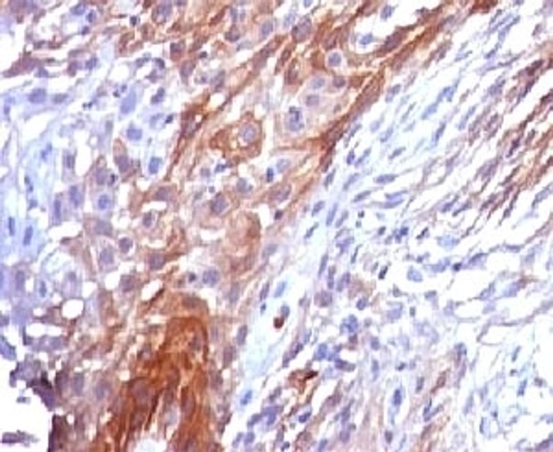 IHC testing of FFPE cervical carcinoma and Cytokeratin 17 antibody.