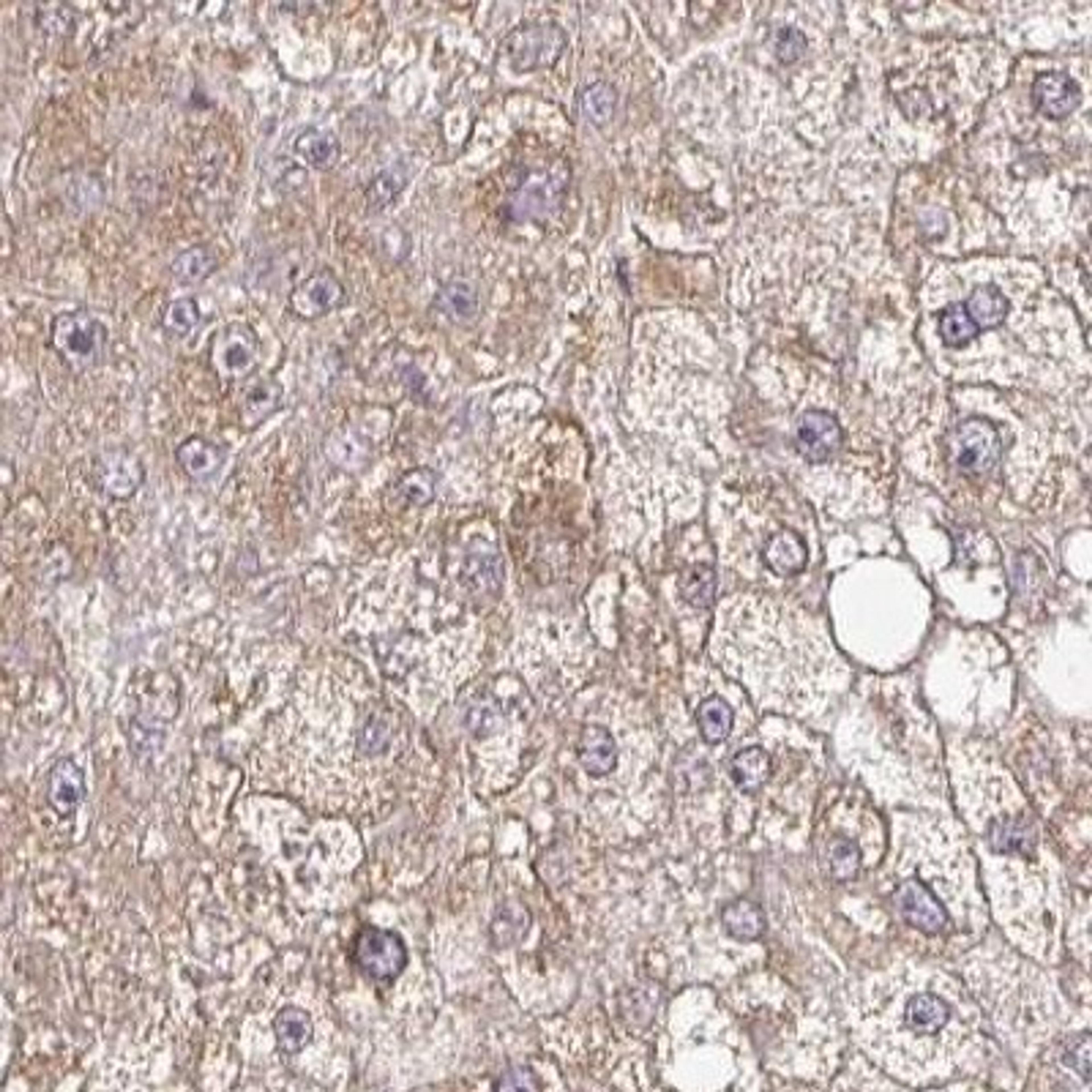 Immunohistochemistry: ZNF322A Antibody [NBP2-32047] - liver cancer