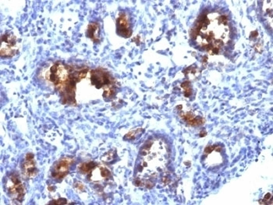 Formalin-fixed, paraffin-embedded human gastric carcinoma stained with MUC3 antibody (MUC3/1154).