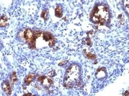 Formalin-fixed, paraffin-embedded human gastric carcinoma stained with MUC3 antibody (MUC3/1154).