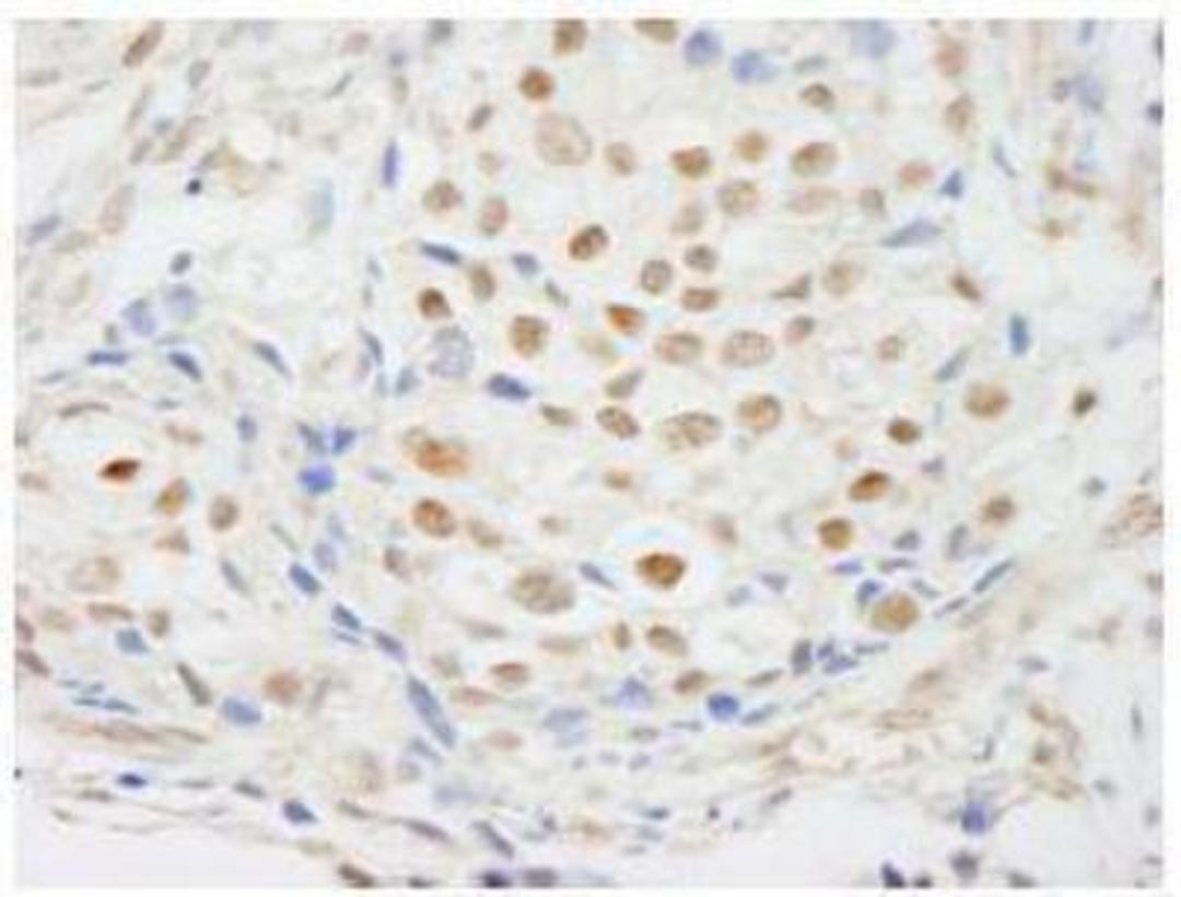 Immunohistochemistry-Paraffin: ZNF318 Antibody [NB100-77289] - Detection of Human ZNF318/TZF. Sample: FFPE section of human breast carcinoma. Antibody: Affinity purified rabbit anti-ZNF318/TZF at a dilution of 1:250.