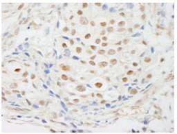 Immunohistochemistry-Paraffin: ZNF318 Antibody [NB100-77289] - Detection of Human ZNF318/TZF. Sample: FFPE section of human breast carcinoma. Antibody: Affinity purified rabbit anti-ZNF318/TZF at a dilution of 1:250.