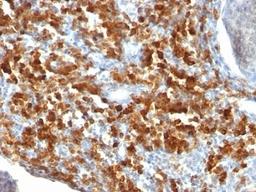 Formalin-fixed, paraffin-embedded human lymphoma stained with CD79a antibody (IGA/515).