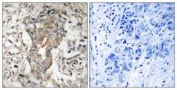 Immunohistochemistry-Paraffin: SPHK2 Antibody [NBP1-67487] - Analysis of paraffin-embedded human breast carcinoma tissue, using SPHK2  Antibody. The picture on the right is treated with the synthesized peptide.