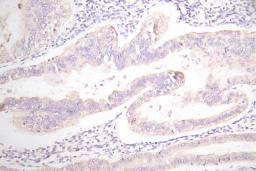 IHC image of CSB-RA007717MA1HU diluted at 1:100 and staining in paraffin-embedded human endometrial cancer performed on a Leica BondTM system. After dewaxing and hydration,  antigen retrieval was mediated by high pressure in a citrate buffer (pH 6.0). Section was blocked with 10% normal goat serum 30min at RT. Then primary antibody (1% BSA) was incubated at 4°C overnight. The primary is detected by a Goat anti-Mouse IgG labeled by HRP and visualized using 0.05% DAB.