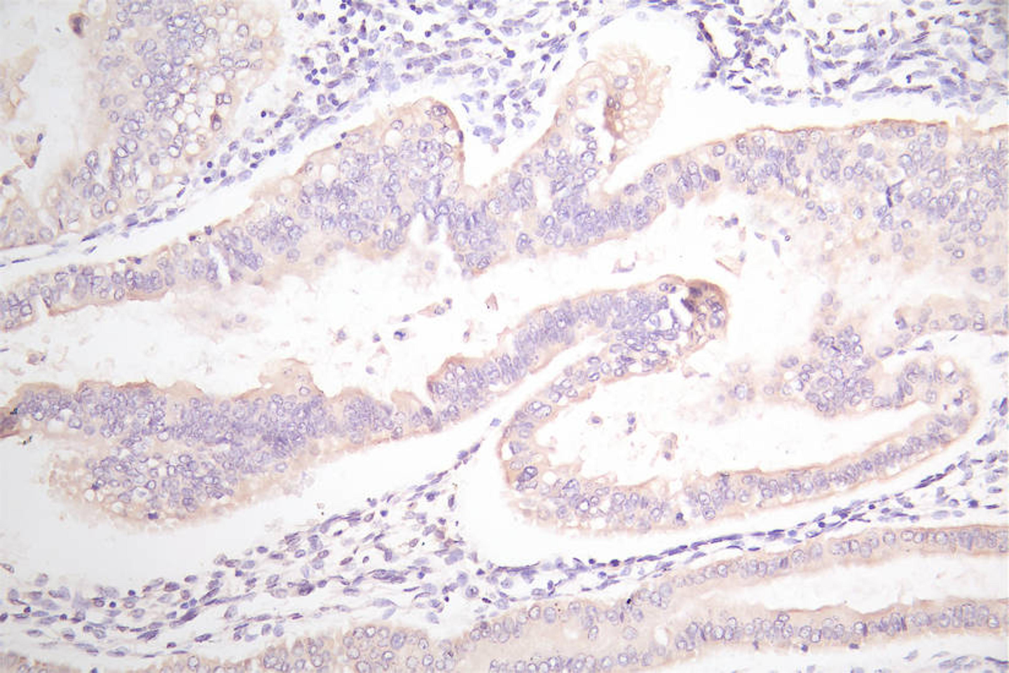IHC image of CSB-RA007717MA1HU diluted at 1:100 and staining in paraffin-embedded human endometrial cancer performed on a Leica BondTM system. After dewaxing and hydration,  antigen retrieval was mediated by high pressure in a citrate buffer (pH 6.0). Section was blocked with 10% normal goat serum 30min at RT. Then primary antibody (1% BSA) was incubated at 4°C overnight. The primary is detected by a Goat anti-Mouse IgG labeled by HRP and visualized using 0.05% DAB.