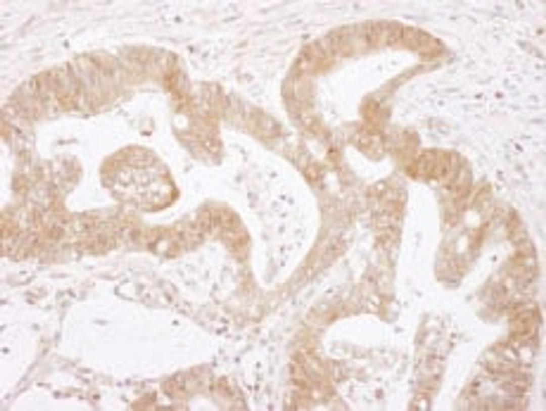 Detection of human Caspase 3 by immunohistochemistry.