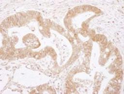 Detection of human Caspase 3 by immunohistochemistry.