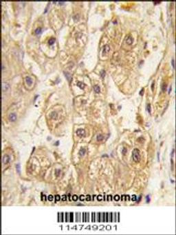 Formalin-fixed and paraffin-embedded human hepatocarcinoma tissue reacted with PDGFRB antibody , which was peroxidase-conjugated to the secondary antibody, followed by DAB staining.