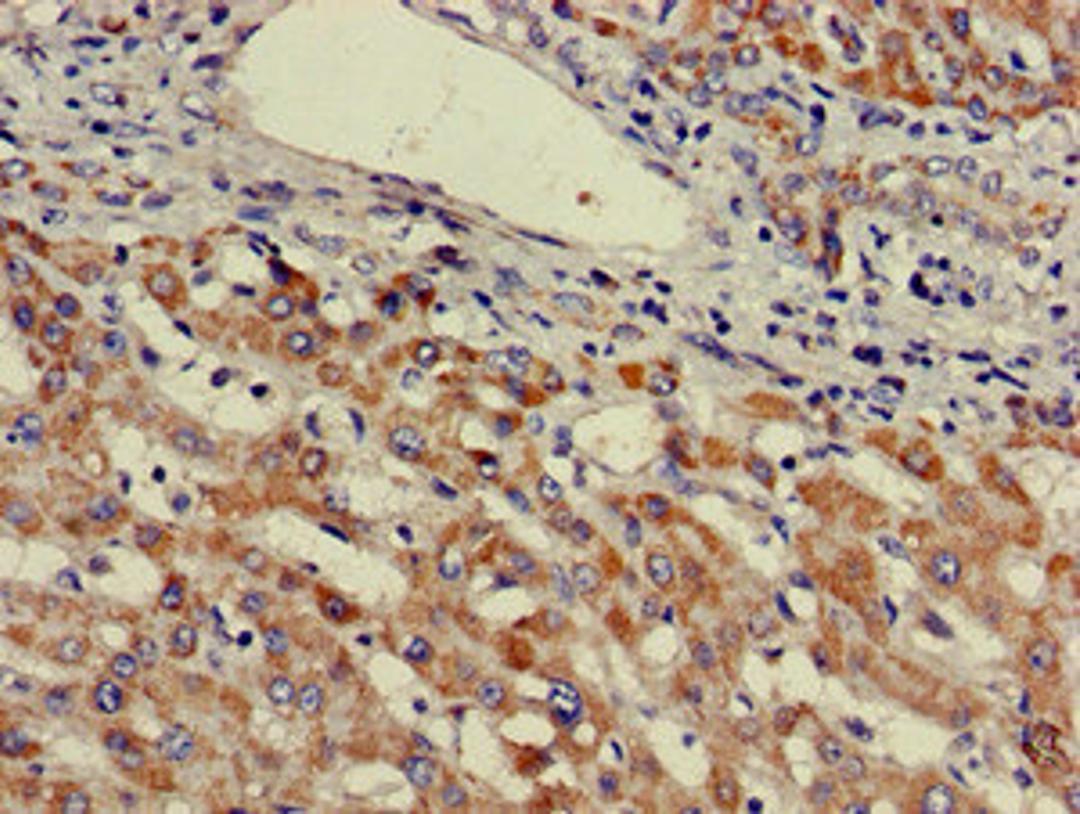 Immunohistochemistry of paraffin-embedded human liver cancer using CSB-PA025488LA01HU at dilution of 1:100