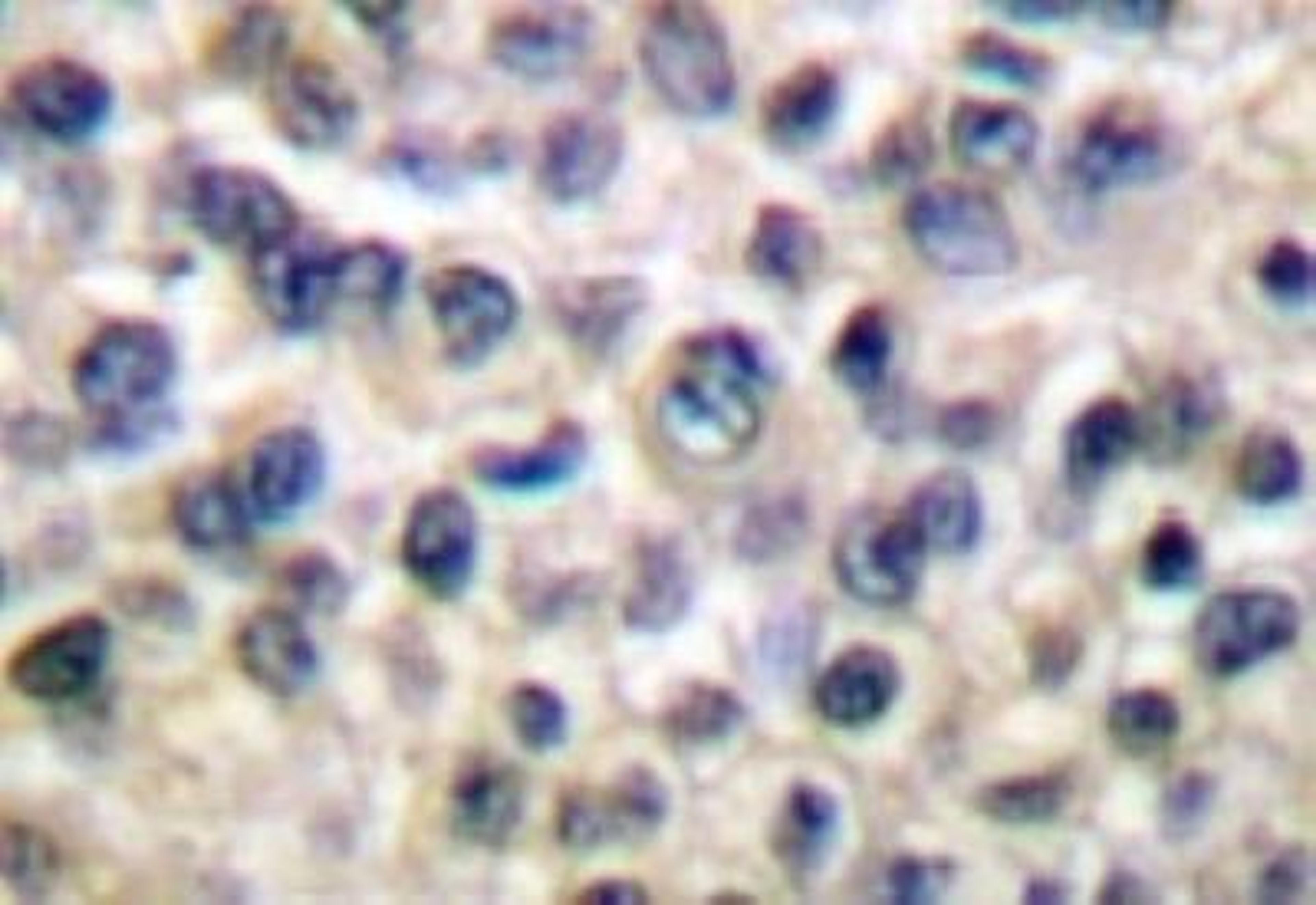 Immunohistochemistry: MMP14 Antibody [NB100-91872] -  - Immunohistochemistry  (IHC)  analyzes of MMP-14  (P509) antibody in paraffin-embedded human breast  carcinoma tissue