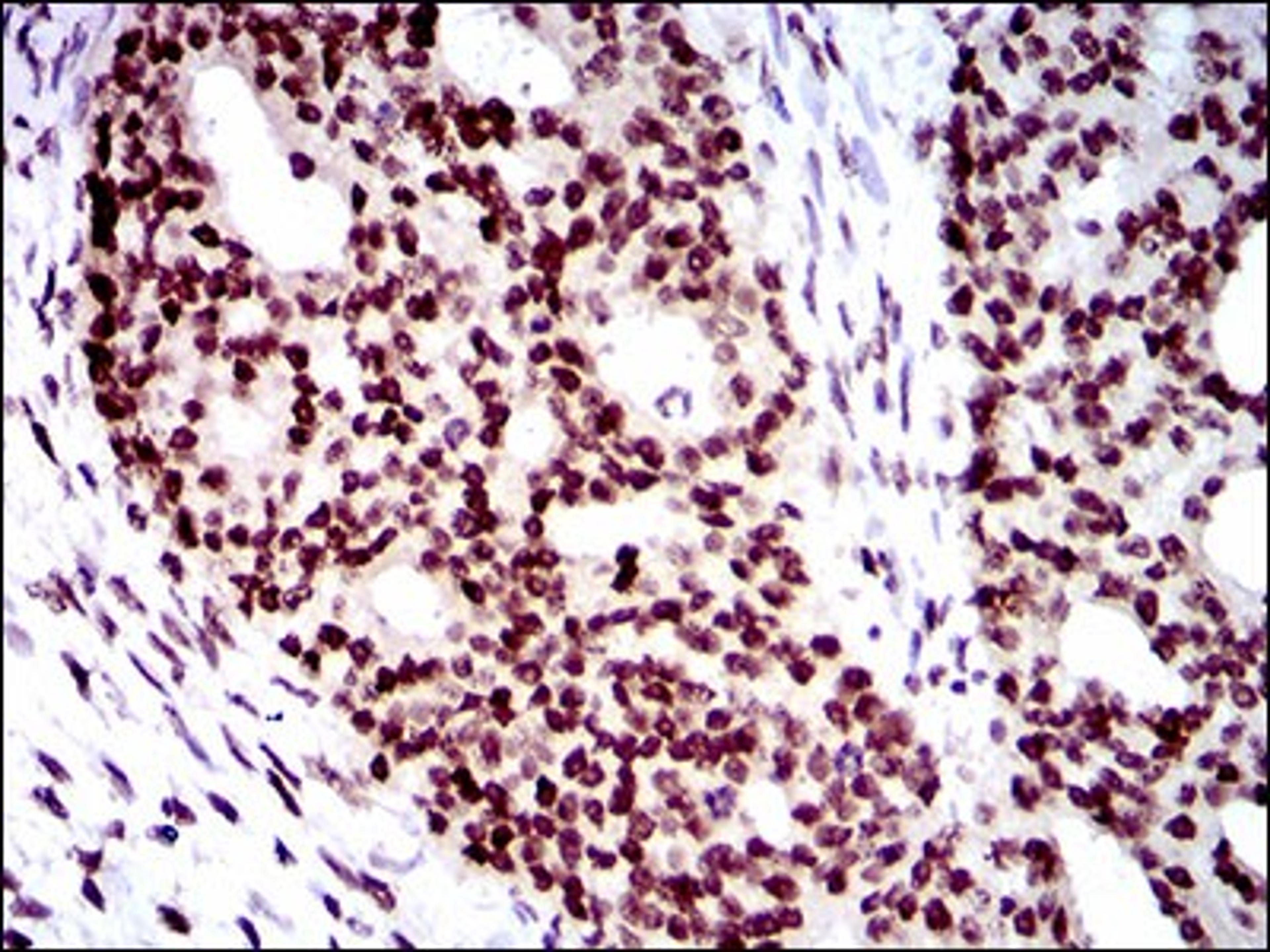 Immunohistochemistry: WHSC2 Antibody (6B11H8) [NBP2-37394] - Immunohistochemical analysis of paraffin-embedded ovarian cancer tissues using WHSC2 mouse mAb with DAB staining.