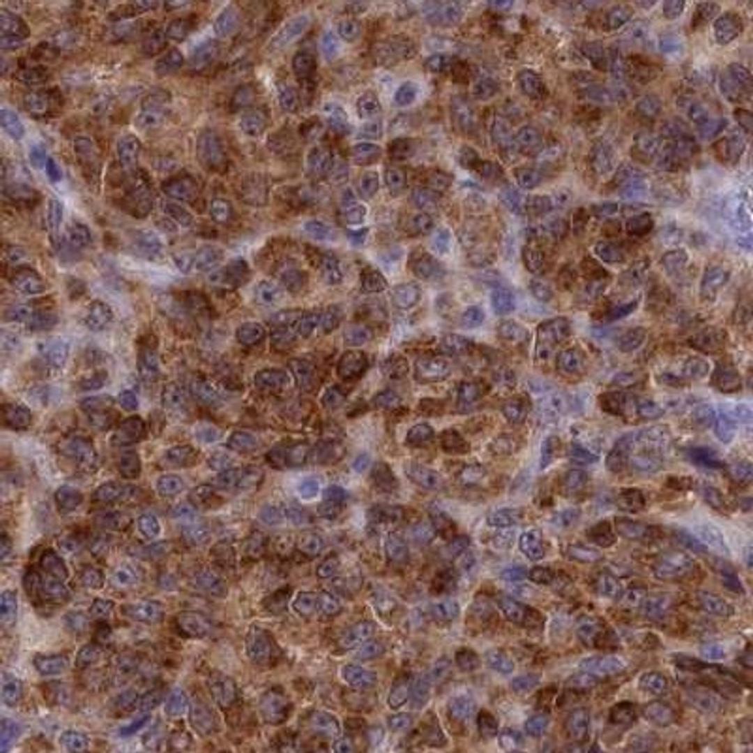 Immunohistochemistry: GAPDHS Antibody [NBP2-31925] - melanoma