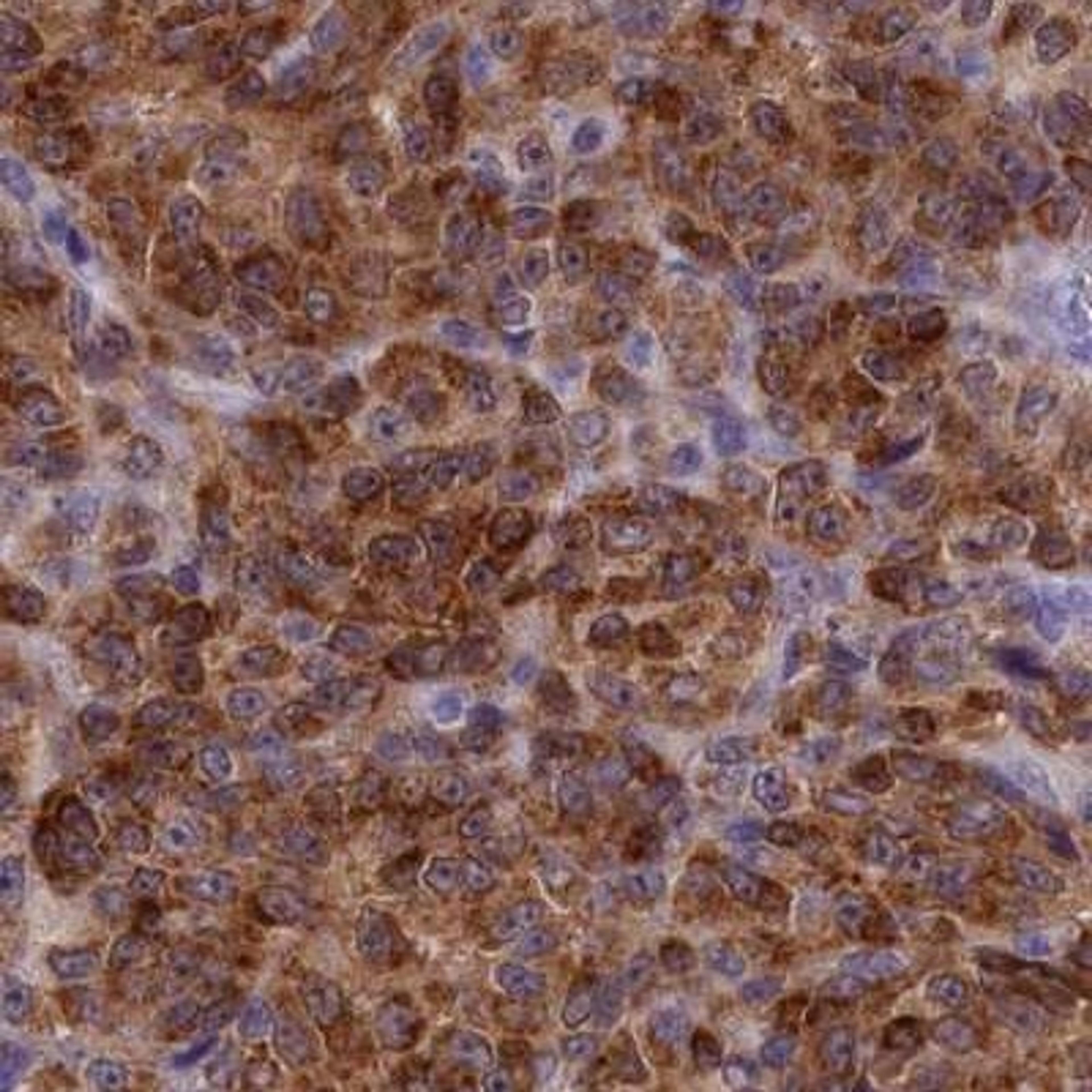 Immunohistochemistry: GAPDHS Antibody [NBP2-31925] - melanoma