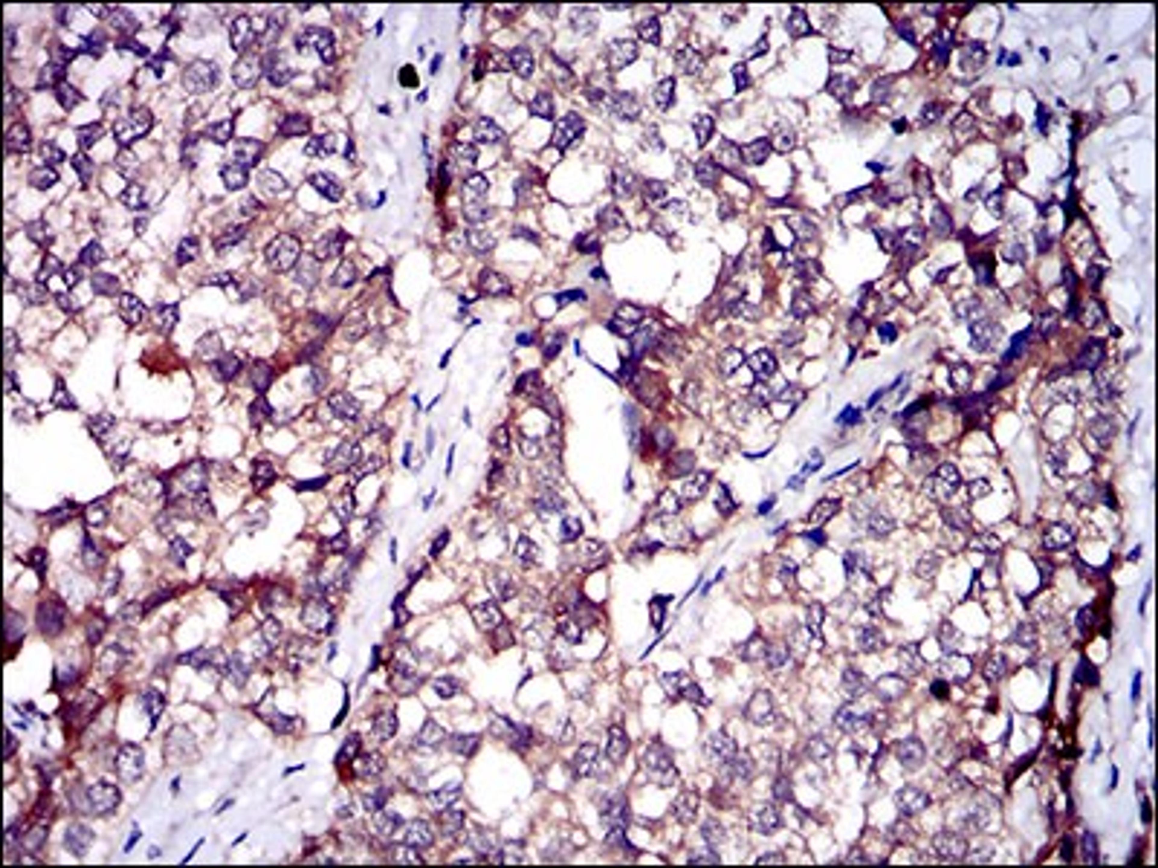 Immunohistochemistry: Serpin A7/TBG Antibody (5B11E9) [NBP2-37322] - Immunohistochemical analysis of paraffin-embedded bladder cancer tissues using SERPINA7 mouse mAb with DAB staining.