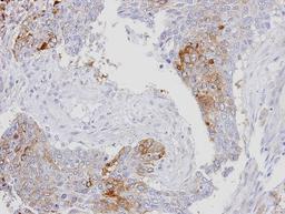 Immunohistochemistry-Paraffin: RanBP16 Antibody [NBP1-32350] - Paraffin-embedded lung SCC, using antibody at 1:100 dilution.