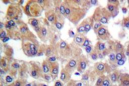 Immunohistochemistry-Paraffin: TGF-beta 1 Antibody [NB100-91995] - Paraffin-embedded human breast carcinoma tissue.