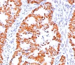 IHC staining of human colon carcinoma with p53 antibody (BP53-12).