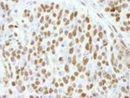 Immunohistochemistry-Paraffin: CTR9 Antibody [NB100-68205] - FFPE section of human breast carcinoma.  Affinity purified rabbit anti-CTR9 used at a dilution of 1:250.