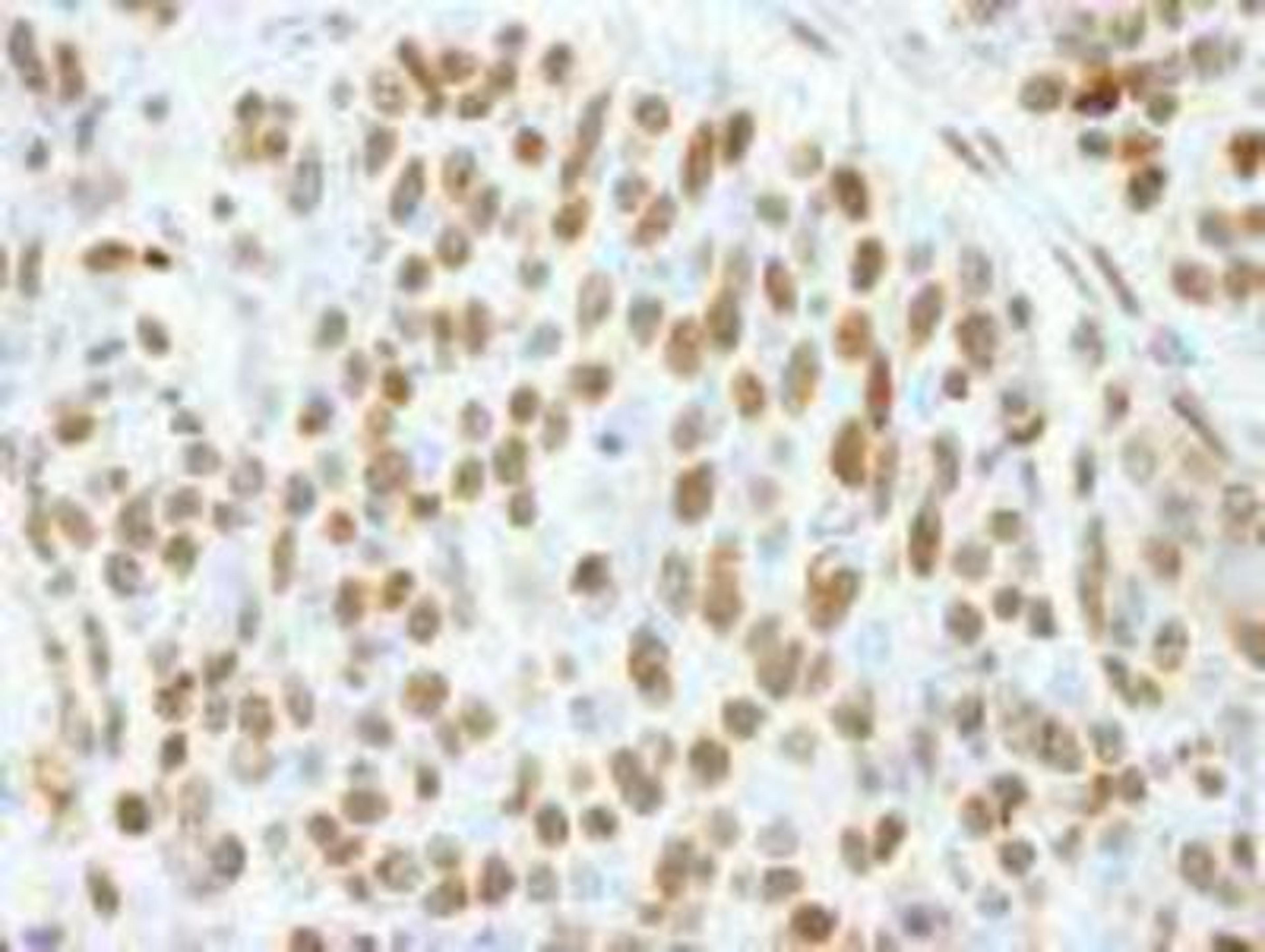 Immunohistochemistry-Paraffin: CTR9 Antibody [NB100-68205] - FFPE section of human breast carcinoma.  Affinity purified rabbit anti-CTR9 used at a dilution of 1:250.